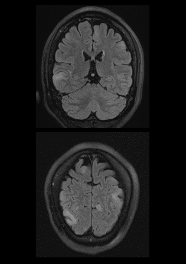 Perampanel Treatment Multifocal Epilepsy : 12 Months Follow Up