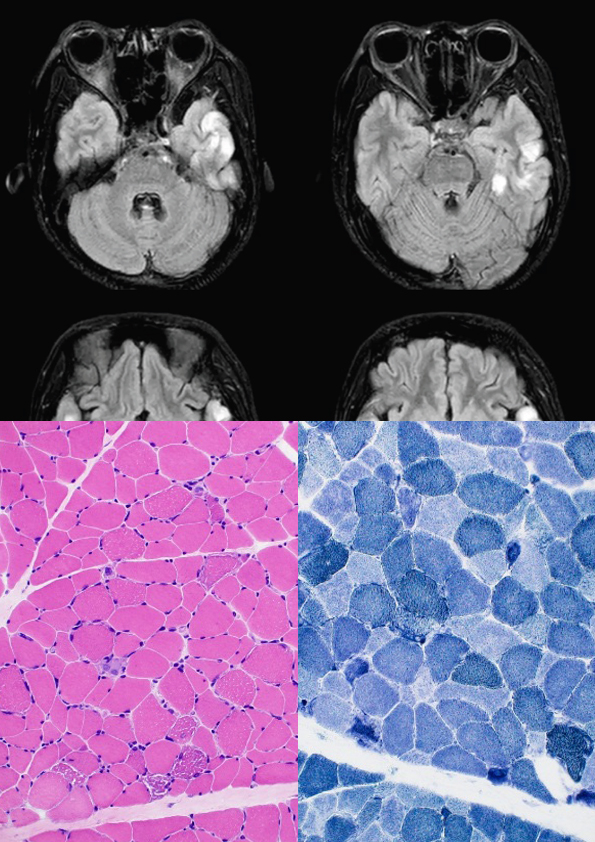 A Young Lady with Stroke-like Episodes and Status Epilepticus