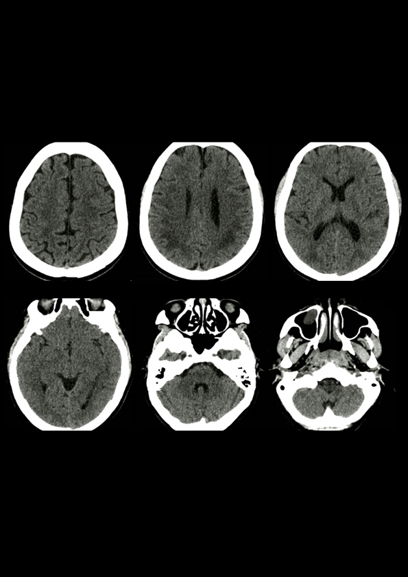 COVID-19-Associated Acute Dissiminated Encephalomyelitis (ADEM)