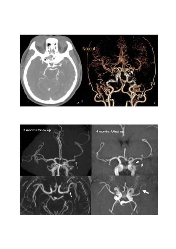 Diagnostic Dilemma in A Man Who Presented with Headache and Transient Memory Loss