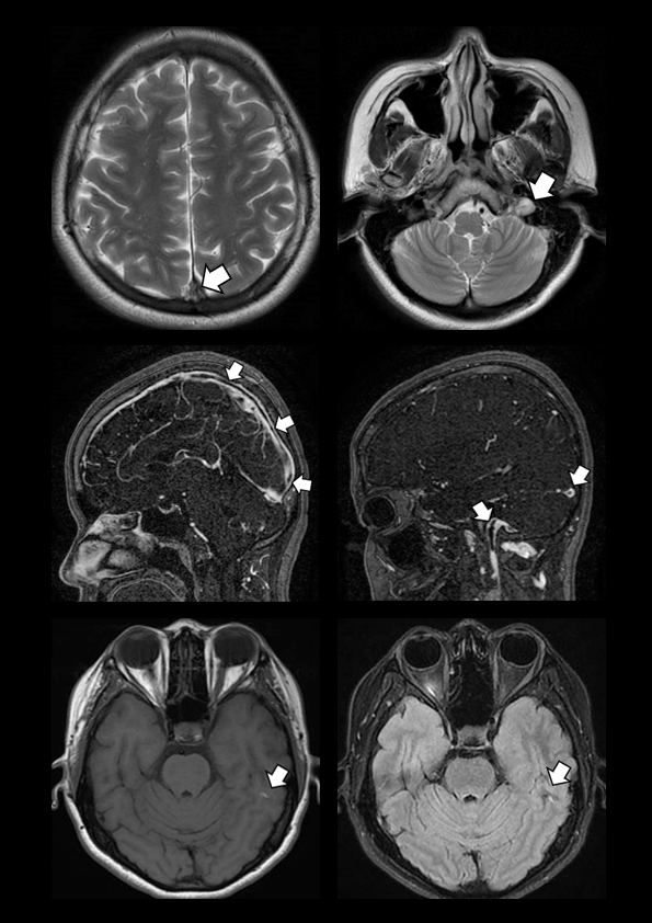 Headache with Increased Intracranial Pressure